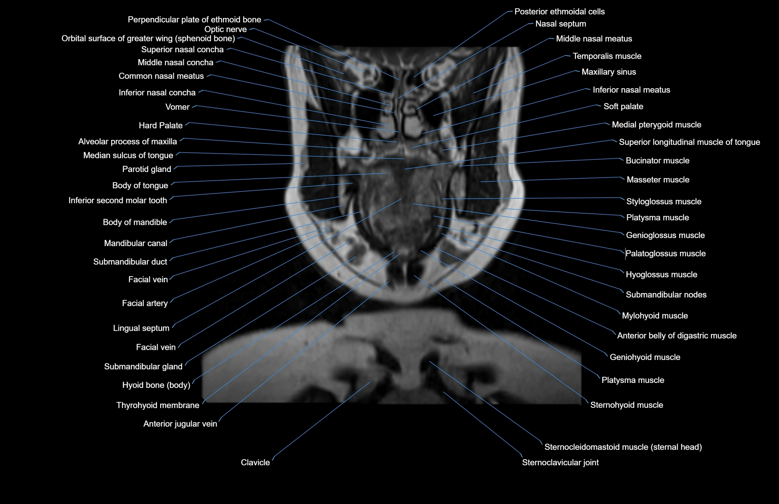 Neck coronal cross sectional MRI anatomy 3T MRI  image-img-00001-00053.webp